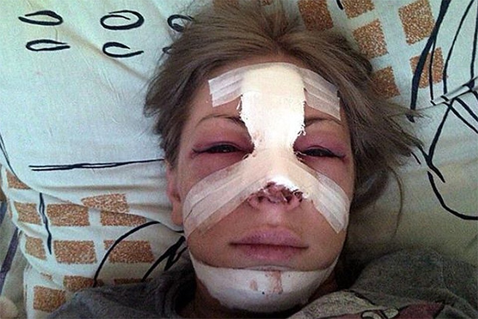 Одна неудачная пластическая операция стоило красавице потери здоровья и конца карьеры