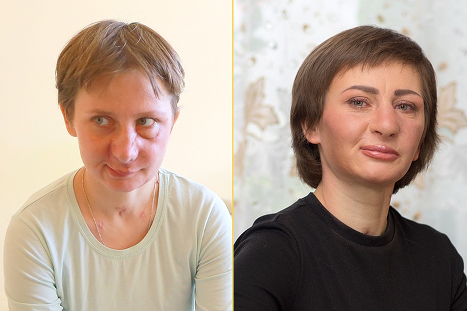 Такой (слева) Марина была сразу после того, как ей восстановили лицо. А так (справа) выглядит сегодня. Фото: Мария ЛЕНЦ и Валерий БЛИНОВ