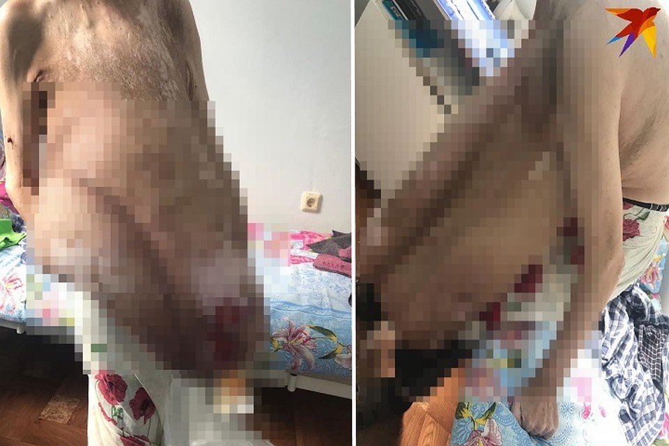Хирурги КБР успешно удалили опухоль