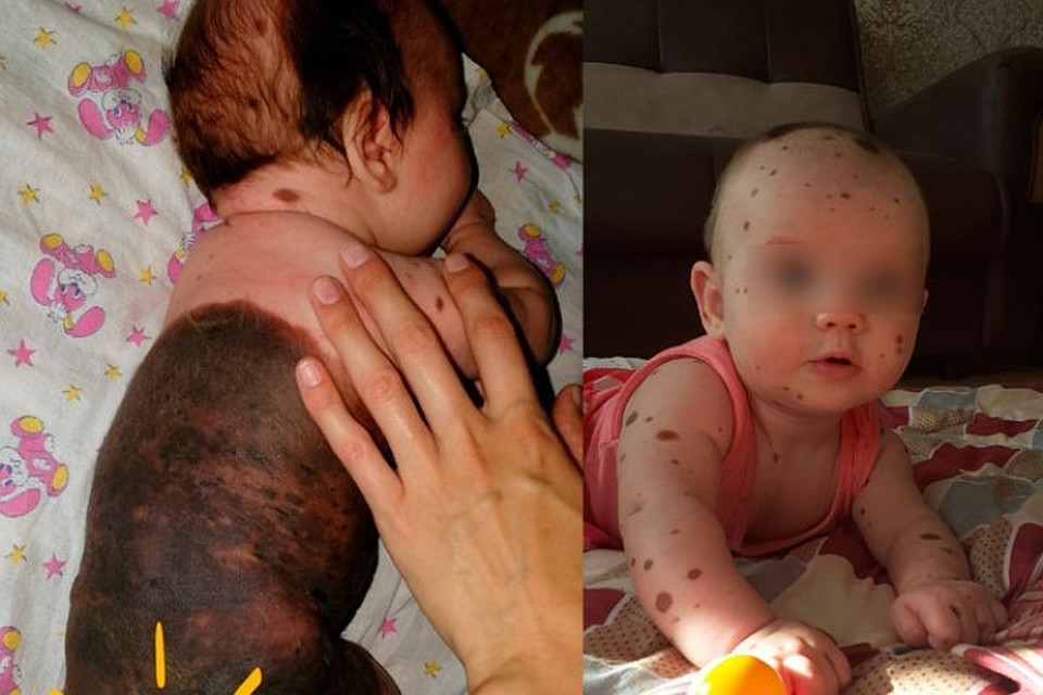 По фотографиям с первого взгляда можно и не понять, что с Викой что-то не так: кажется, будто малышка одета в темно-коричневый комбинезончик. ФОТО: Личный архив