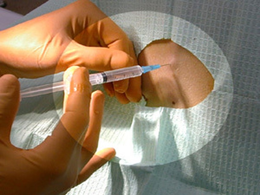 Как сделает циркумцизию Как сделает циркумцизию