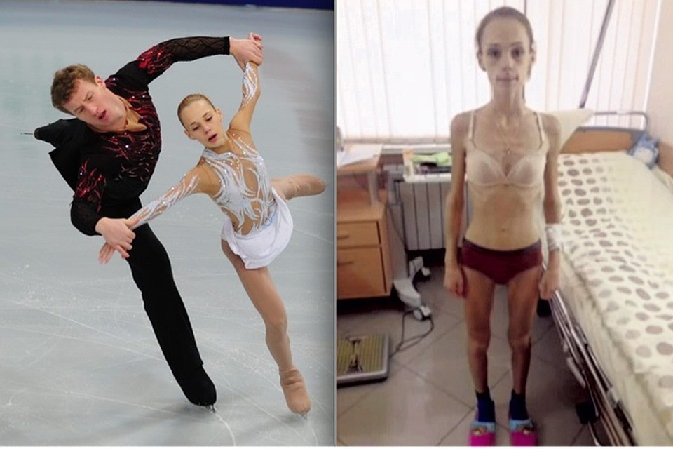 Вот так Юля Антипова выглядела осенью 2013 года на льду. И летом 2014 года в больнице, где у фигуристки побывала съемочна группа программы "Прямой эфир" с телеканала Россия1.