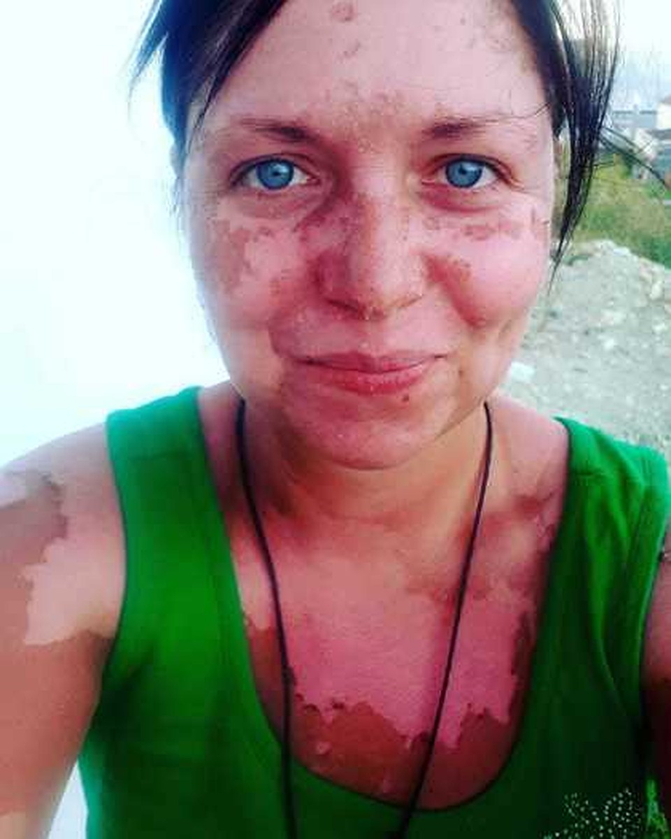 От палящего солнца было невозможно спрятаться, кожа слезала тонким слоем.