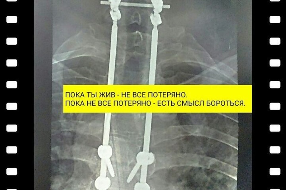 Вот такая конструкция стоит в его позвоночнике. Фото: архив Влада Филина