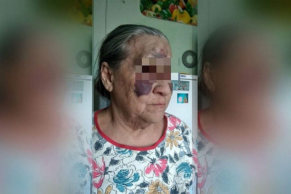 Бабушка получила травмы лица