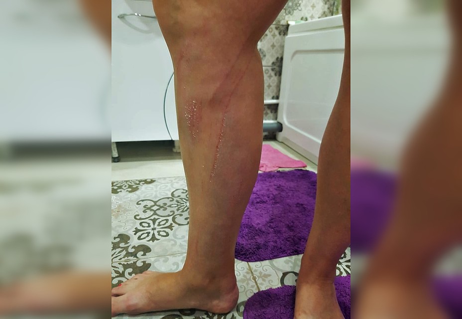Женщина получила ушибы и ссадины рук, ног и туловища Фото: vk.com