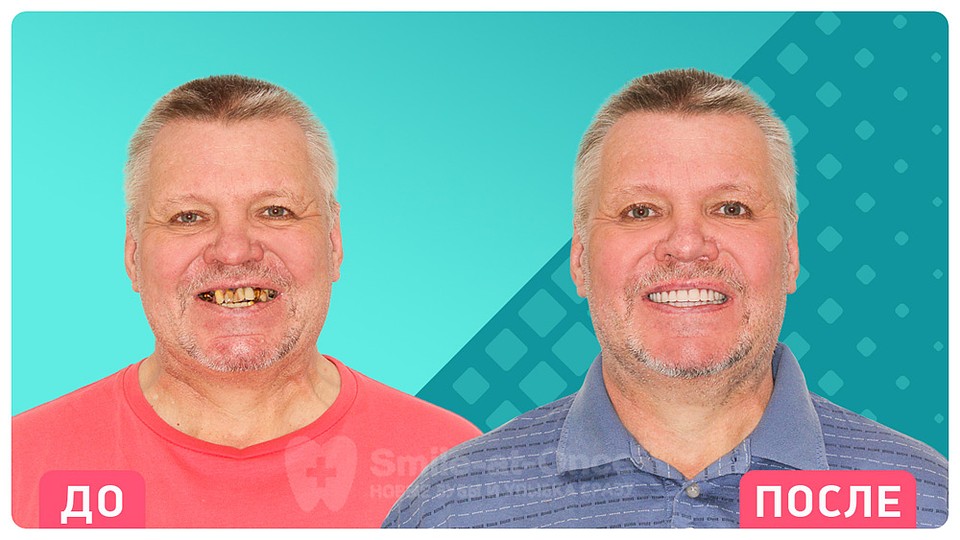 Так меняются пациенты стоматологии Smile-at-Once после проведения имплантации зубов.