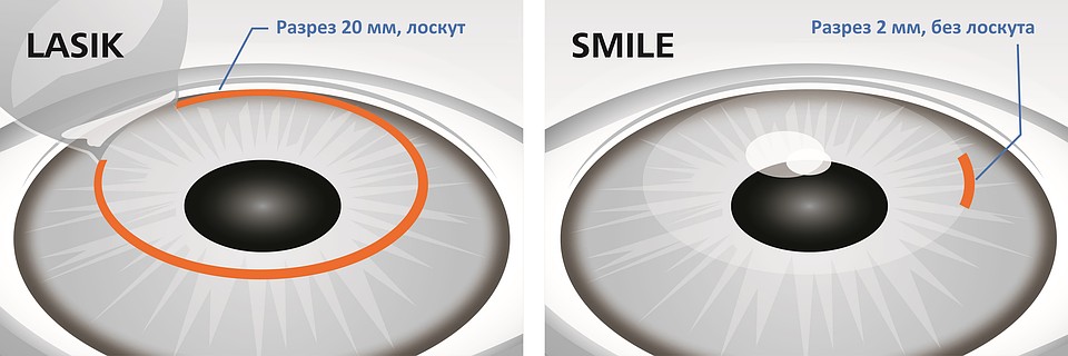 На сегодняшний день ReLEx SMILE – самая комфортная и щадящая для пациента технология лазерной коррекции.