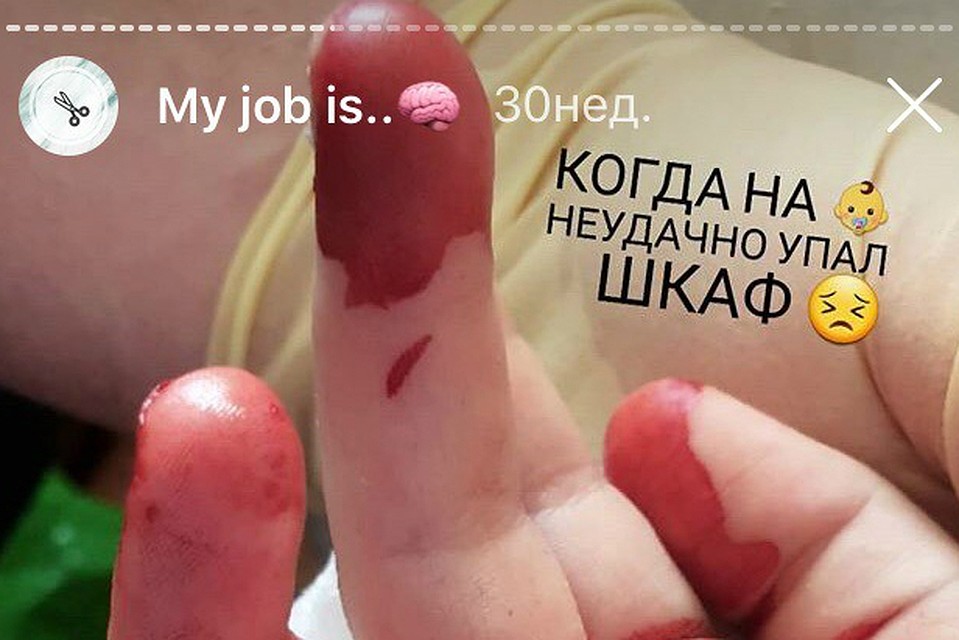 Показать картинку полностью мы не можем - зрелище не для слабонервных. Источник: Инстаграм.