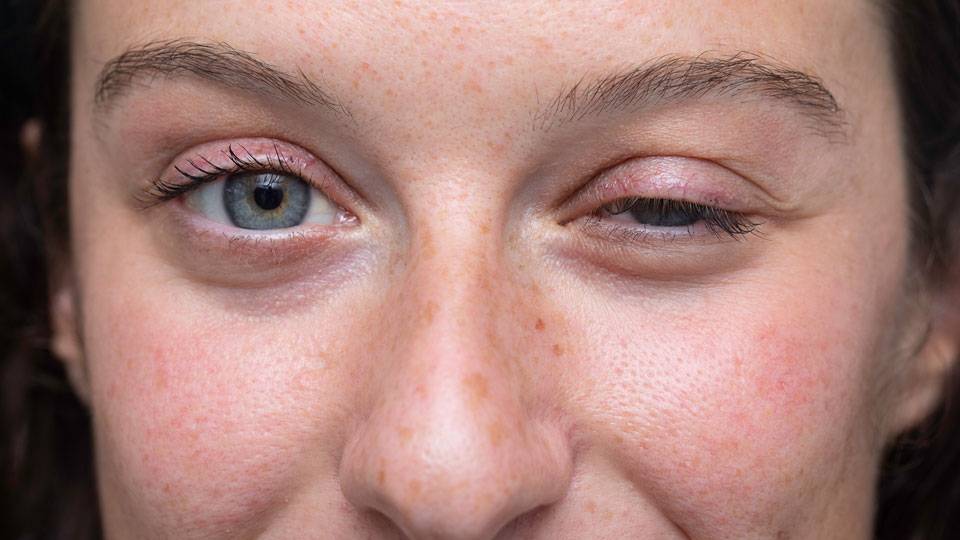 Проблемы с глазами