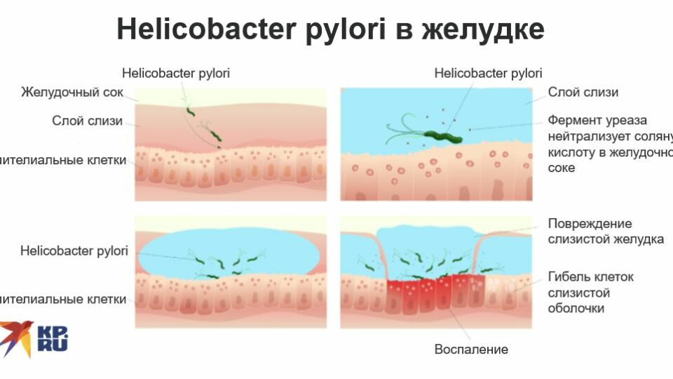 Helicobacter pylori в желудке