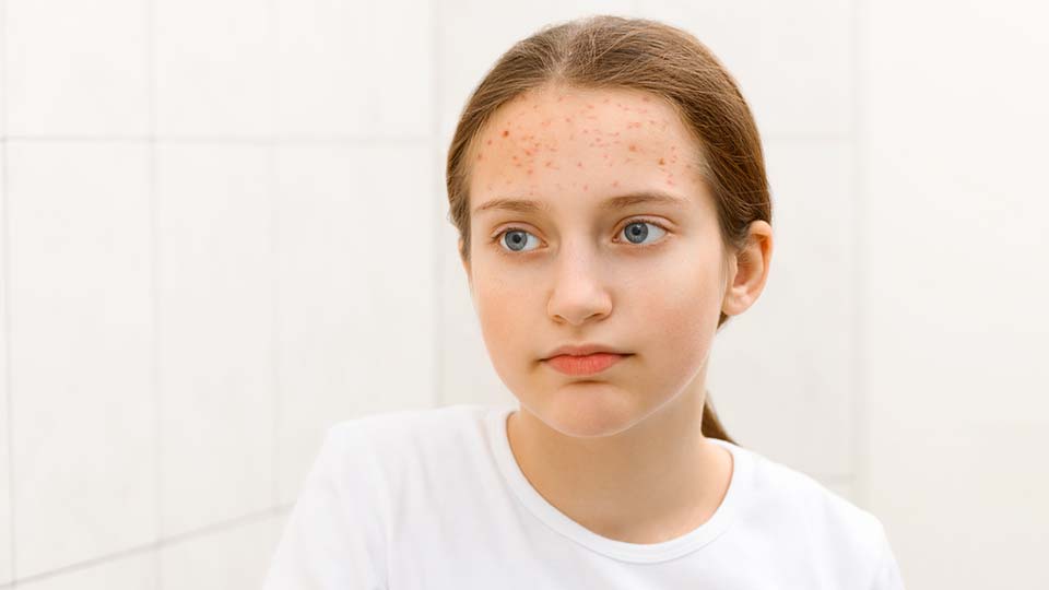 Прыщи у подростка: что делать и чем лечить в 2025 году