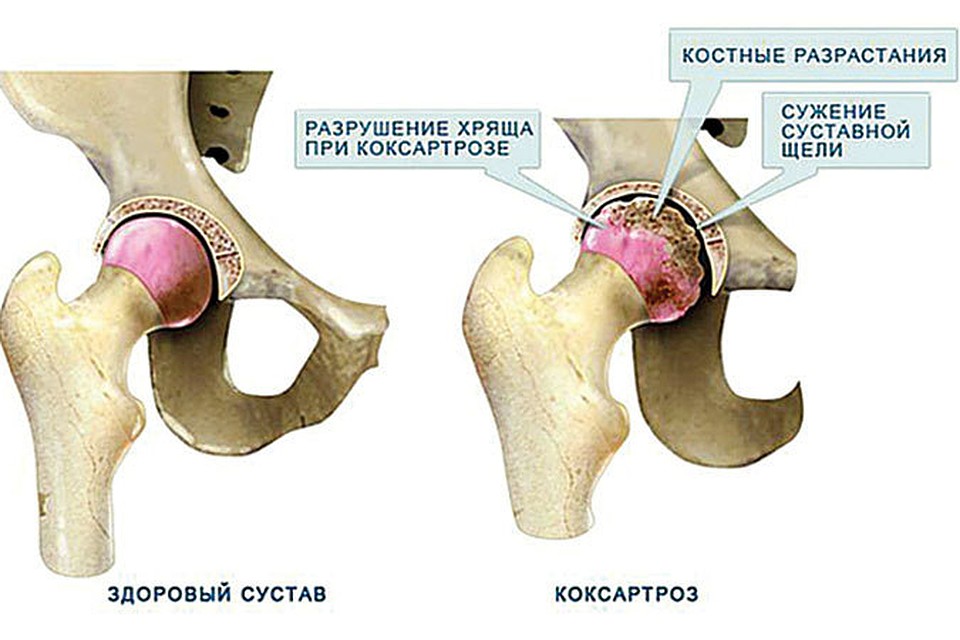 перелом сустава локтя